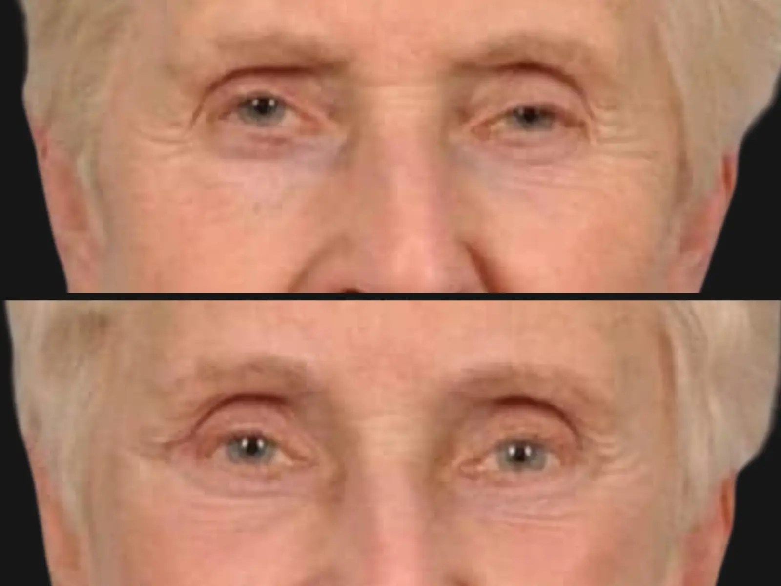 Advanced blepharoplasty for droopy eyelids abu dhabi